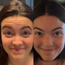 Buy Baby Botox Online