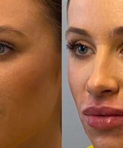 Buy Botox Lip Flip Online